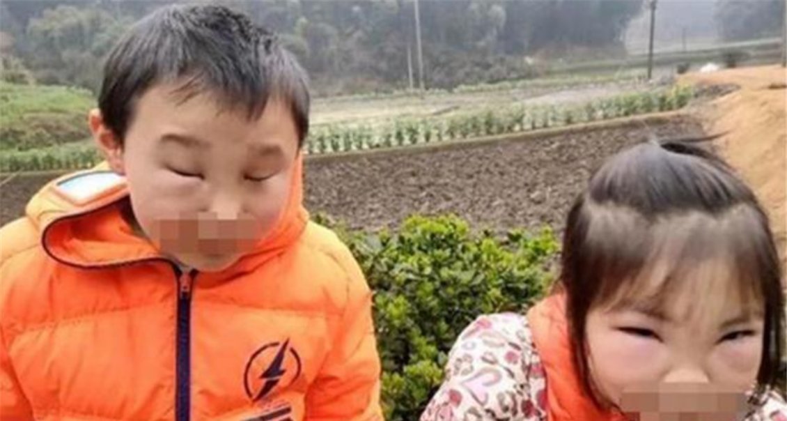 危险|“熊孩子”兄妹捅马蜂窝,蜇得爸妈认不出,网友不该笑但忍不住