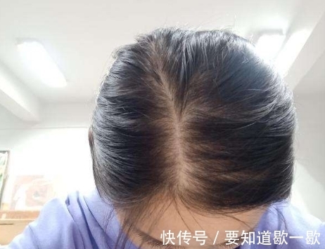 秃顶 你的发量不多,情愿剪短发,也别瞎留这些“秃顶发型”!