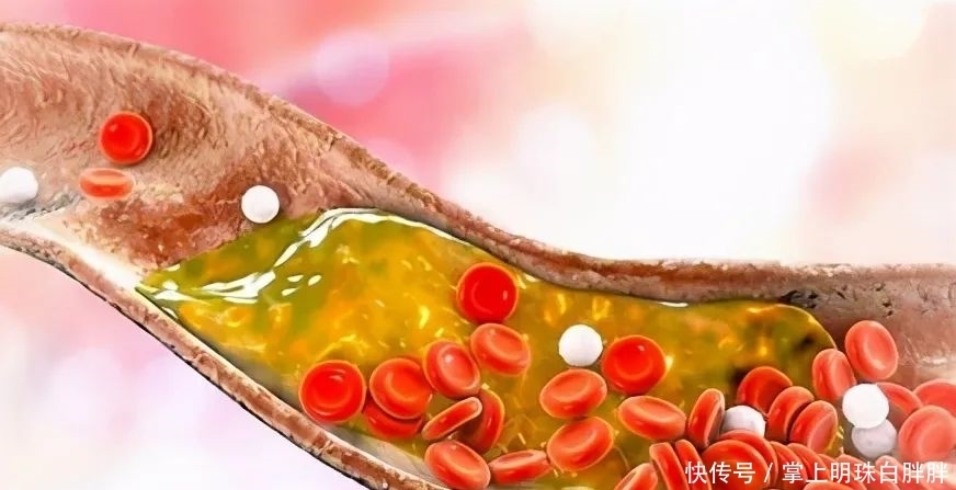 做了血脂检查怎么看报告,只要异常就需要吃药吗?