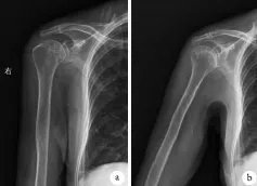 钙化性肌腱炎|长在肩膀上的“结石”:6旬阿姨肩膀半夜痛醒误以为肩周炎,原来是肩袖钙化性肌腱炎