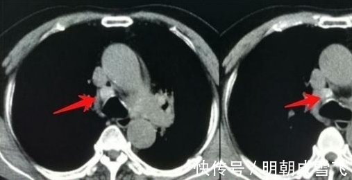 病人|癌症晚期病人差异这么大？有人可以5年以上，有人只有9天寿命？