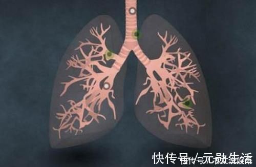 感冒|连续咳嗽了一个月，结果诊为肺癌早期，普通感冒咳嗽有什么差别