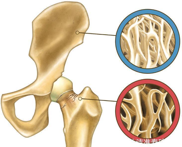 钠离子|厨房一物,或许是在摧毁你的骨骼,医生提醒40岁后尽量少吃