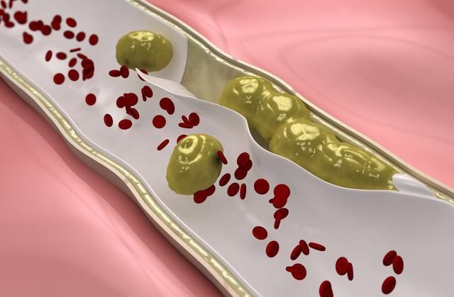 血管堵塞|血栓的“克星”找到了，3种蔬菜每天吃一吃，血液干净，血管不堵