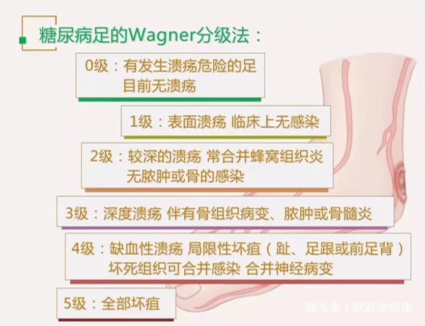 症状|糖尿病足是每个糖友的“噩梦”!医生提醒出现4个症状就该警惕