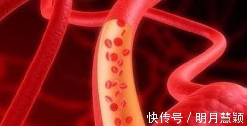 血脂异常|血脂高了别发愁,常吃这6种食物,可以疏通血管,远离“血栓”