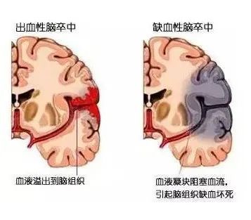 黄金时间|天气寒冷警惕脑卒中，把握急救“黄金时间窗”