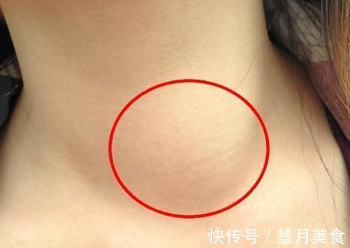 蒲公英|甲状腺出现结节不要怕,记住5吃3不吃,结节或许会慢慢变小!