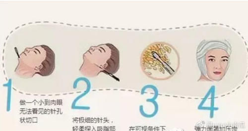 吸脂|下颌缘吸脂和双下巴抽脂有啥区别两个手术可以一起做吗?