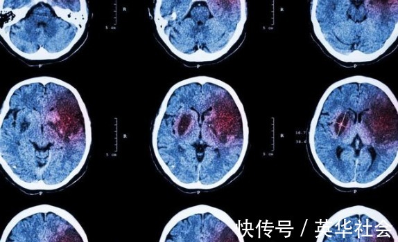 高血压|血压高的人,身体若有''1麻1红1疼'',尽早就医,警惕脑出血