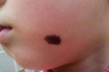 坏习惯|怀孕后,孕妈常有这3个“坏习惯”,宝宝易长胎记,一定要多留心