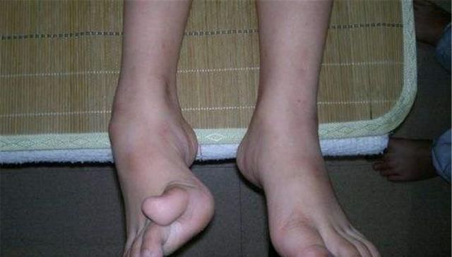 孩子|这种鞋子易导致孩子''脚变形'',很多家长还在给娃穿,别大意