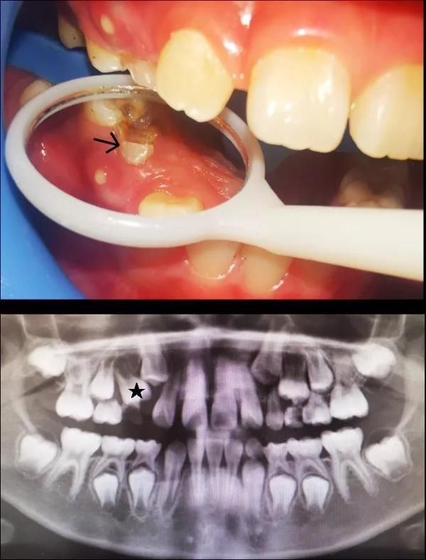 6岁孩子长出双排牙，都怪家长“太勤快”？这种方式，爸妈们要改改……
