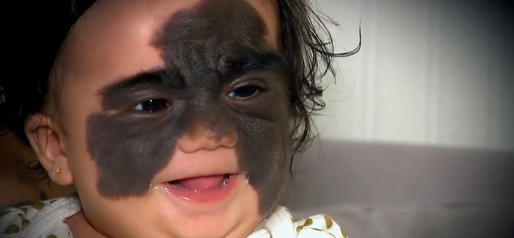 孕期|那个脸上有“蝙蝠”胎记的女孩,如今生活的怎么样?看完很欣慰