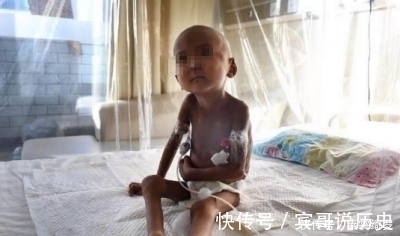 泪目|3岁女孩瘦的跟骷髅一样,天天喊饿父母却不给吃,真相让人泪目