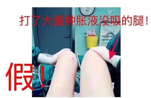 吸脂术后出现“积液”问题，是什么原因呢？