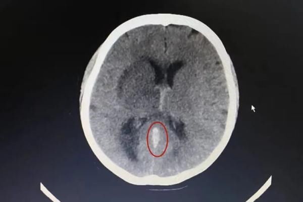 脑血管|女子脑血管“堵”了，竟和长期吃避孕药有关