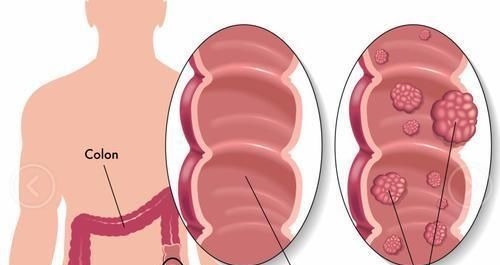 前兆|身上这里长“肉疙瘩”,当心癌症前兆!30岁以上的人,尤其要注意