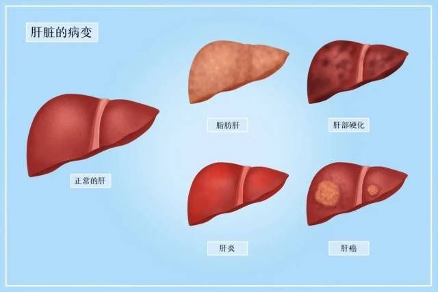 减重|谢博减重话健康｜针灸可以治疗脂肪肝吗？