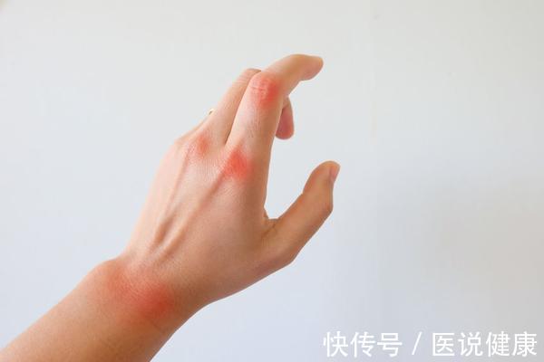 疼痛感|类风湿关节来临时，身体会出现7个症状，多留意身体上的表现