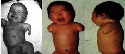 尼克|90后孕妇生下“海豹胎”,曾拒绝医生打掉,如今杂戏团要高价收购