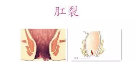 千万警惕｜吸烟竟然能引起肛裂？长期吸烟的你要小心了！