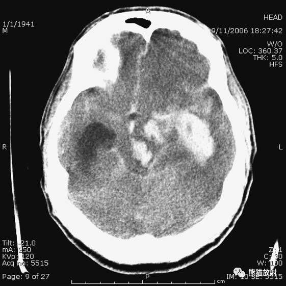 疾病|急诊颅脑CT不能漏的8种疾病