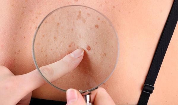 肝脏|肝硬化来临时,通常会有这4种异常,占一个,也要引起注意