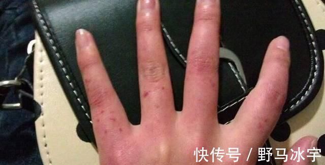 肝脏|生殖系统发出的这3个信号，说明你的肝可能有问题了