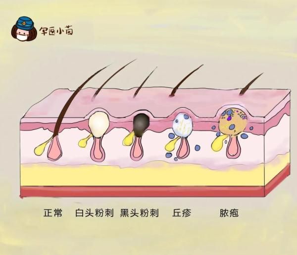 药物治疗|关于“痘痘”那些不得不说的事