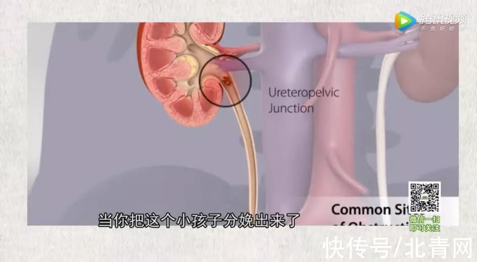 肾绞痛|肾结石究竟是如何形成的？医生劝告：4个诱因及时避开，切莫贪嘴多吃