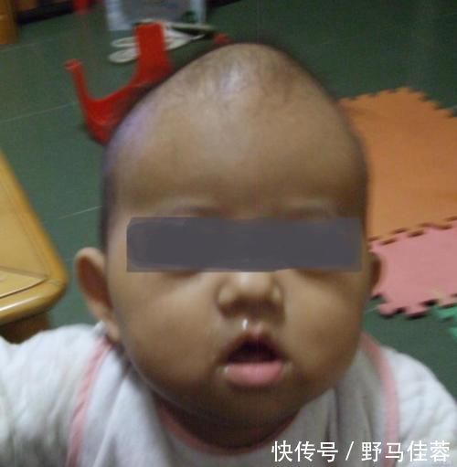 前囟门|囟门被称为宝宝的“命门”,若出现这几种形态,别耽搁赶紧去医院
