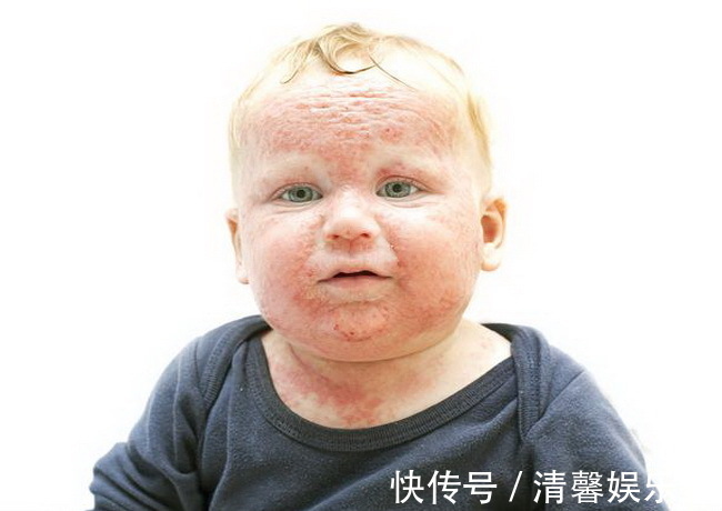 字号|孩子从小爱过敏,长大后过敏就好了不见得