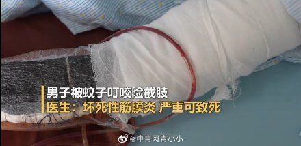 坏死性筋膜炎|男子被蚊子叮咬后发高烧险截肢 医生：严重可致死