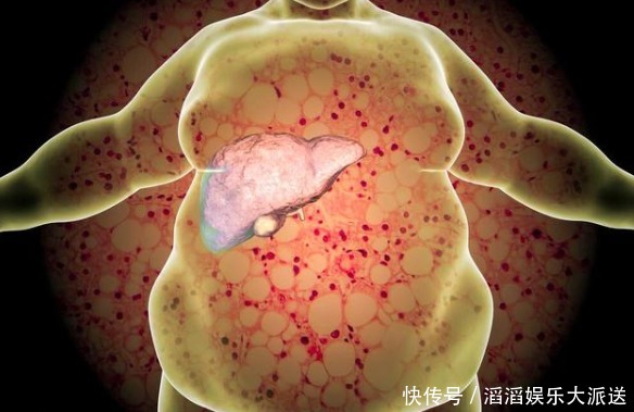 这2种食物是“痛风元凶”,挨饿也别吃,伤肝伤肾很严重