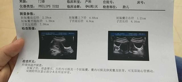 时间也会|怀孕后，胎心、胎芽多久才会出现？出现时间早晚受这三个原因影响