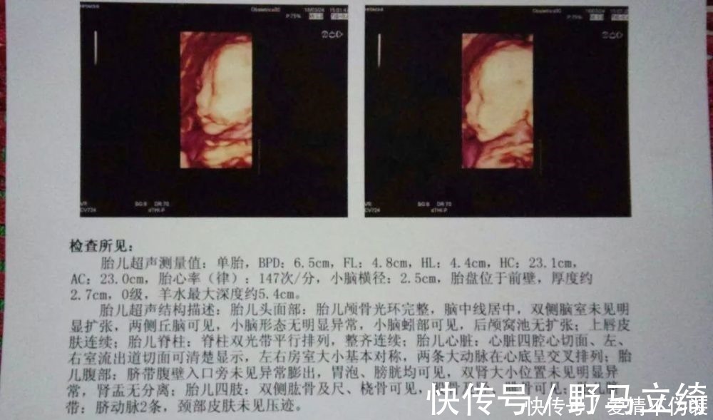 鉴定|一张四维彩超轻松看出胎儿性别,孕妈先别高兴的太早