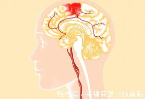 跳广场舞|33岁女子,跳广场舞突然晕倒,脑溢血离世,医生惋惜:2件事要了她的命!