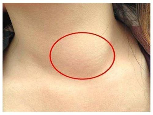 结节|体内有肿瘤，看脖子就知道？脖子有这2种“迹象”，说明出问题了