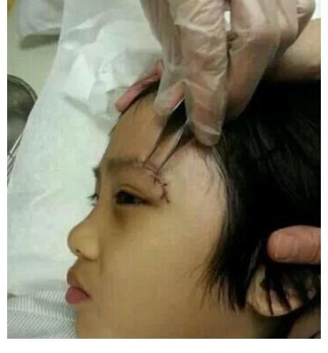 永久性|錄《爸爸去哪兒》造成眼角永久性傷害，13歲費(fèi)曼露無(wú)劉海正臉