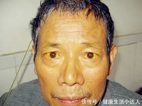 肝脏|肝脏有病，不易察觉？身体三处有异常，真的要好好查查肝了