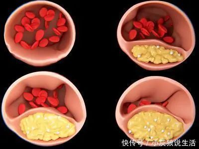 两味中药煮水喝，活血化瘀通血管，预防心梗、脑梗