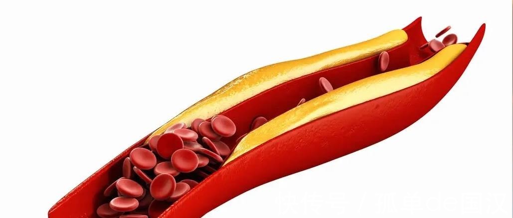 高血糖|高血脂或是“吃”出来的预防高血脂,这“3物”尽量要少吃