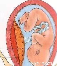 宫颈|分娩时,出现以下8种情况的产妇务必选择剖腹产,千万别犹豫误事