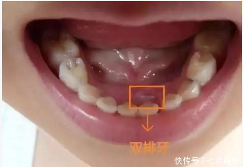 每个孩子|6岁孩子长出双排牙,赶紧带去医院检查,得知原因宝妈后悔不已