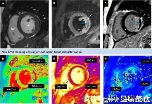 放射治疗|同时被糖尿病和乳腺癌,折磨的女白领,含泪讲述哪个更威胁生命?