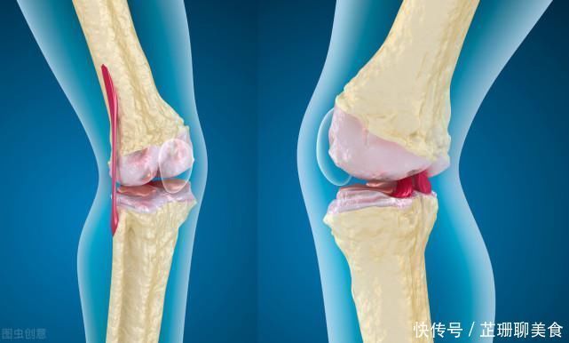 骨科医生:最伤膝盖的2件事,你每天都在做,难怪滑膜炎好不了