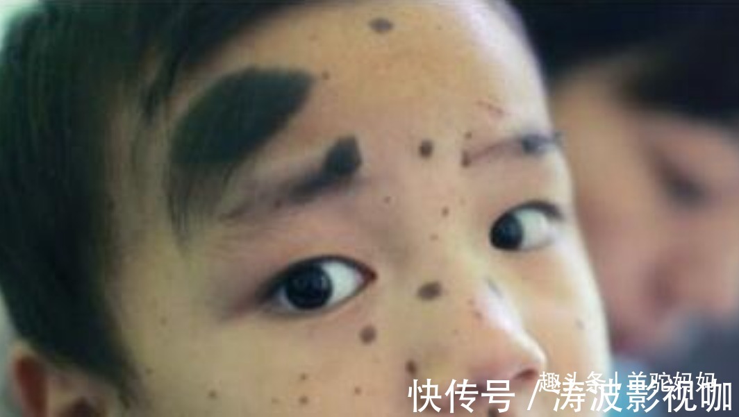 胎儿|越来越多胎儿被“胎记”缠身,若不想孩子自卑,孕妈要管住自己