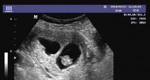 什么是孕囊孕囊和卵黄囊有何区别 快资讯