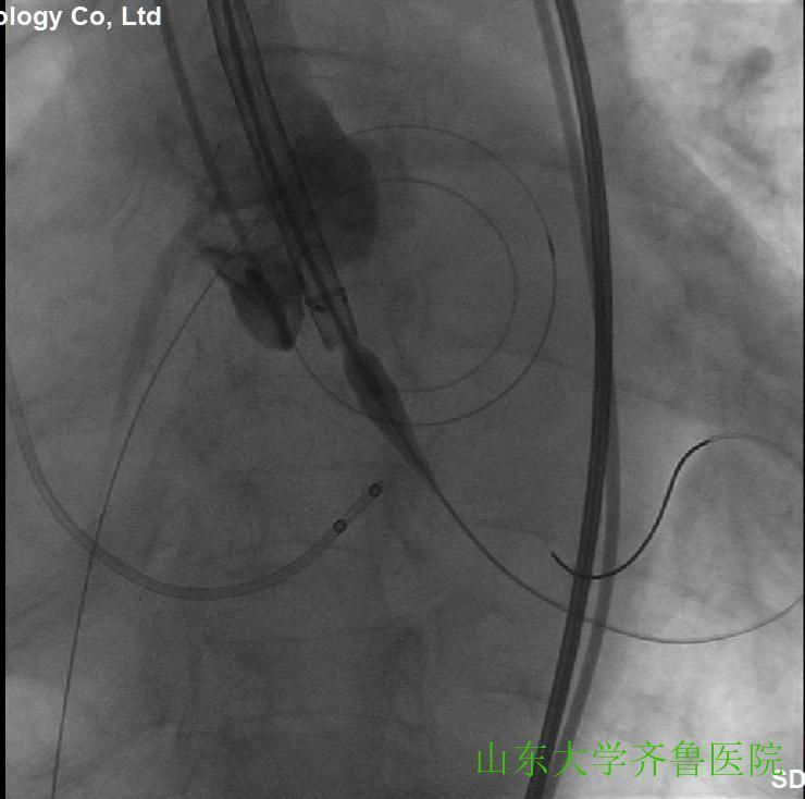 患者|省内首例!齐鲁医院完成一站式经导管主动脉瓣置换术(TAVR)+经皮二尖瓣球囊扩张成形术(PBMV)